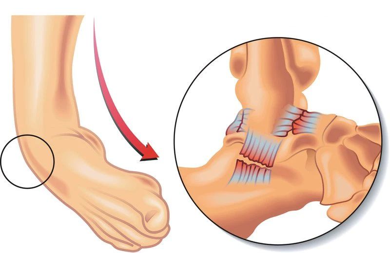 Tầm quan rrojng của viễ xử lý vết thương kịp thời